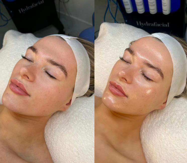 Hud direkt efter en HydraFacial-behandling hos Beauty & Lifestyle i Malmö